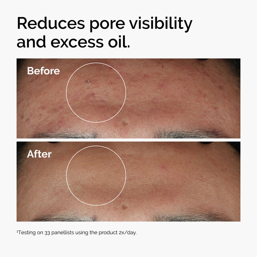 niacinamide-10-zinc-1-h7 ord-niacinamide-zinc-blemish-serum-before-after-pores.jpg