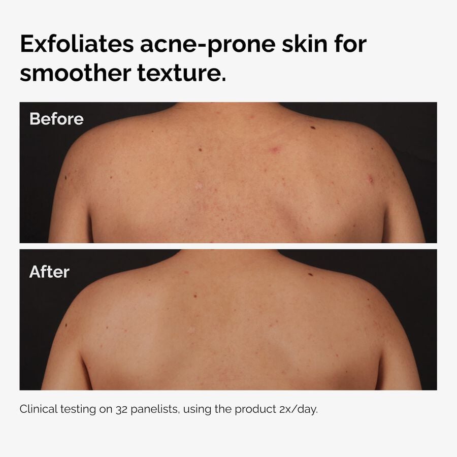 the-body-care-collection-l5 ord-salicylic-acid-body-serum-before-after-graphic-NA.jpg
